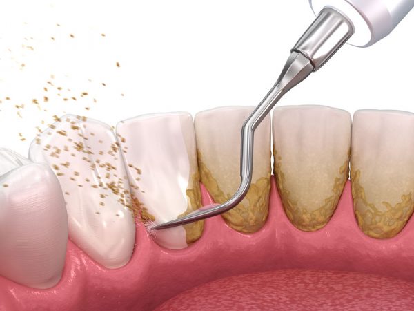 Tooth Colored Fillings in Kenosha, WI