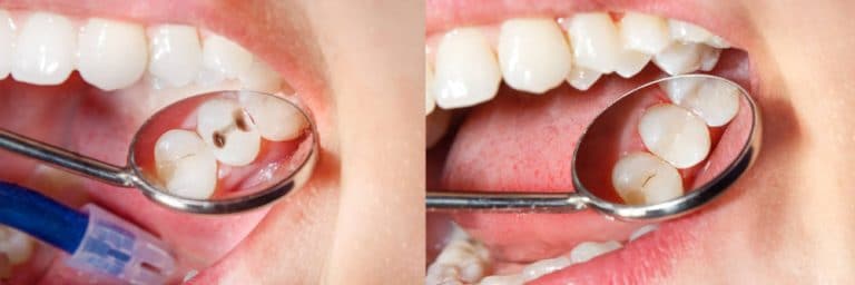 composite fillings in kenosha, teeth cleanings in kenosha, kenosha teeth cleanings