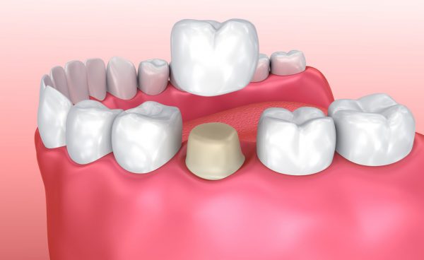 dental crowns in kenosha, kenosha dental crowns, dentist in kenosha