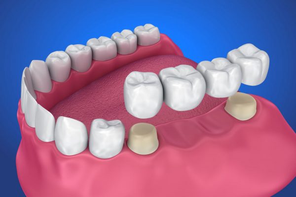 dental bridges in kenosha, fixed dental bridges in kenosha, kenosha dentist that does dental bridges