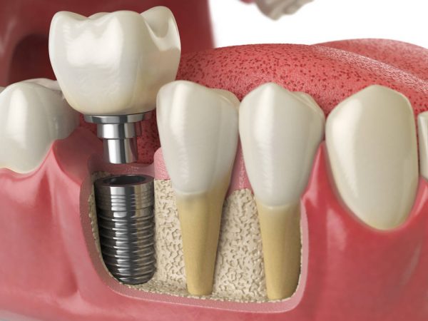 dental implants in kenosha, dental implant restoration in kenosha, kenosha family dentist