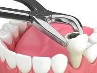 tooth extractions in kenosha, tooth pulling in kenosha, kenosha teeth pulling