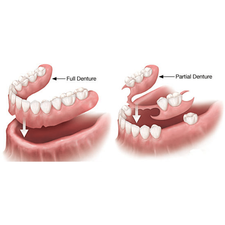 dentures in kenosha, partial dentures in kenosha, partials in kenosha