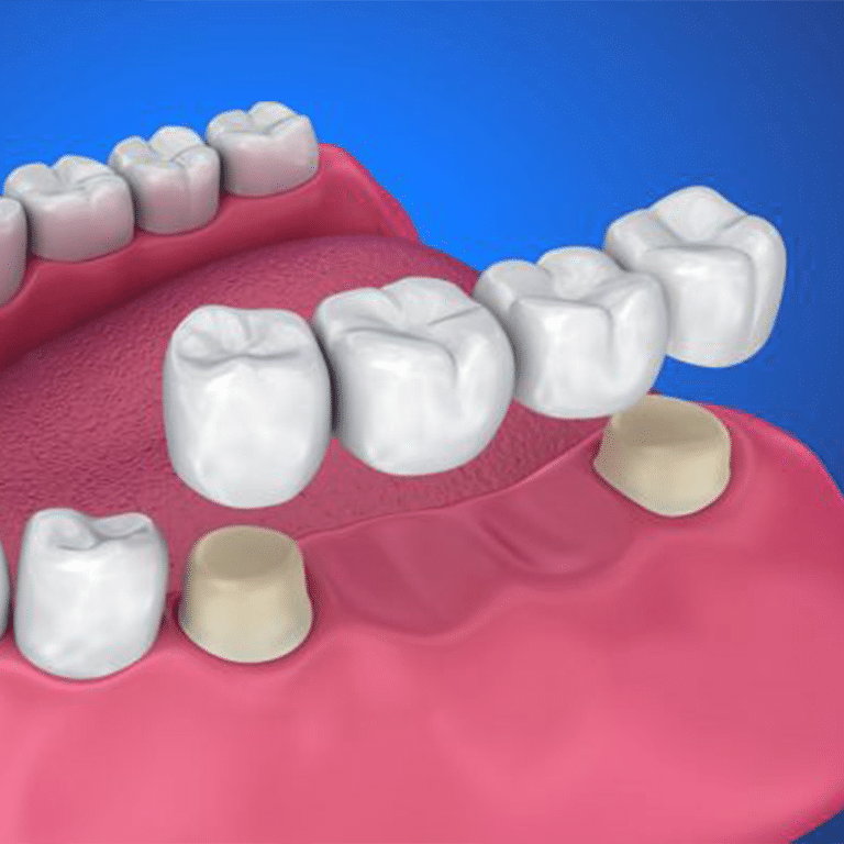 dental bridge kenosha, fixed dental bridge kenosha, kenosha dental care