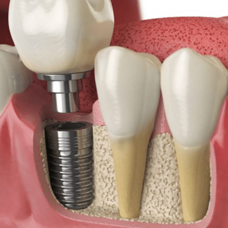 implant restoration in kenosha, kenosha dental services, dental care kenosha