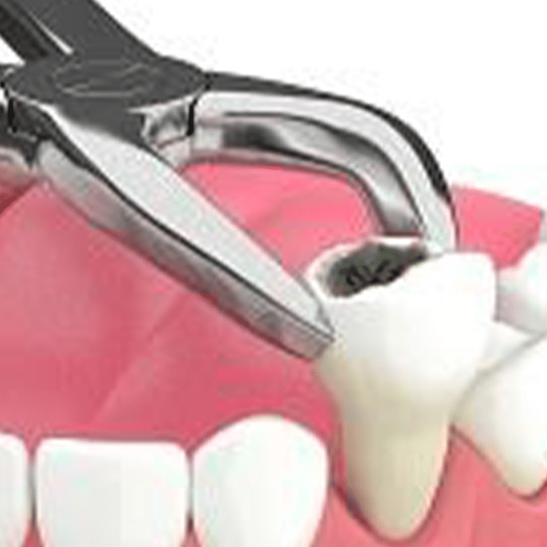 tooth extraction kenosha, kenosha dentist, best kenosha dentist