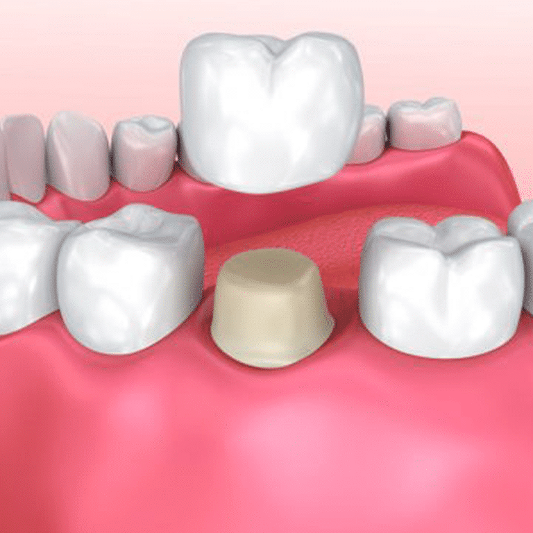 quality Kenosha dental crowns, dental crowns Kenosha WI, Kenosha restorative dentistry
